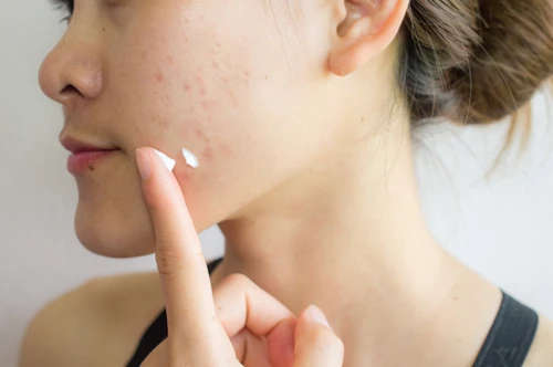 Acne treatment Acne treatment